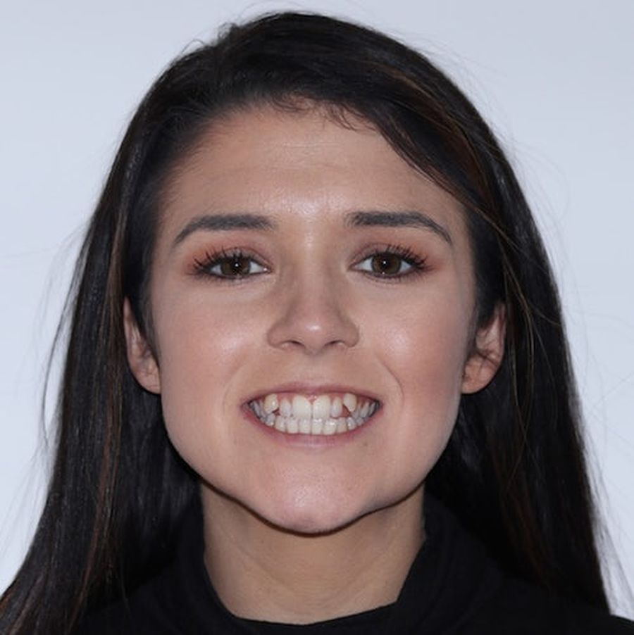Invisalign - Evelyn - before - 3dental